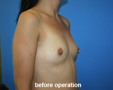 plastic-surgery-breast-augmentation